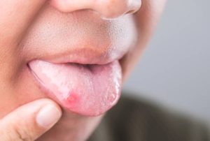 舌頭長小顆粒