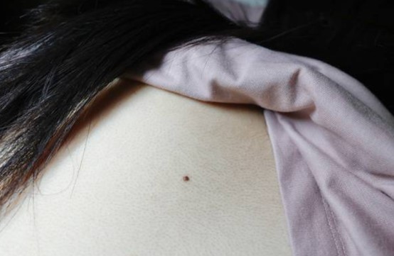 身上的痣越來越多？突然長痣原因、處理方法與預防攻略
  
