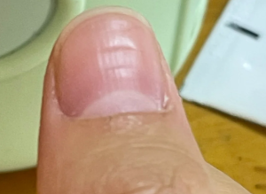 大拇指凹凸不平