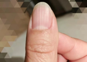 指甲縱紋