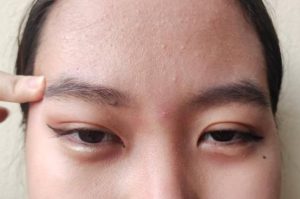 眉心長痘痘