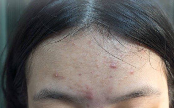 額頭暗瘡總是不退？深度解析額頭生粒粒原因，助你找回平滑肌膚
