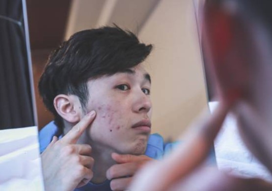 【男士去暗瘡印全攻略】告別月球表面，恢復清爽俐落的型男膚質 
  